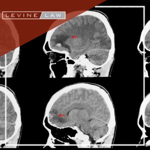Traumatic Brain Injury