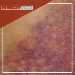 Denver Nursing Home Abuse Attorney